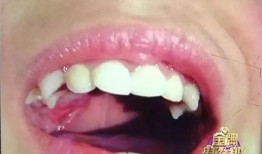 吃瓜磨破上颚正常吗视频,揭秘日常饮食中的意外伤害